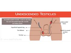 Undescended Testicles