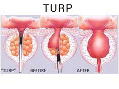 TURP