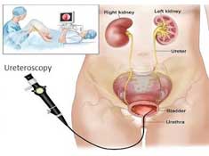 RENAL CALCULI